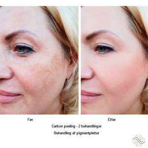 abnikka-pigmentpletter-ansigtsbehandling-carbon-peeling-art-by-nikka