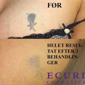 abnikka-yaglaser-uddannelse-tattoo-removal-ecuri